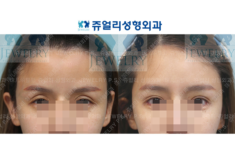 アンチエイジング・リフトの術前・術後写真