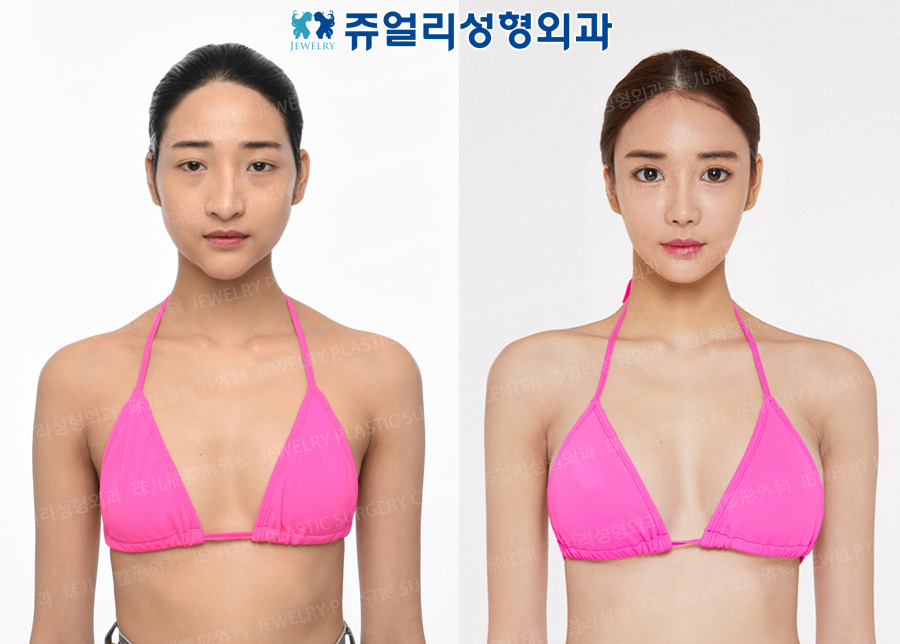 豊胸の術前・術後写真 1