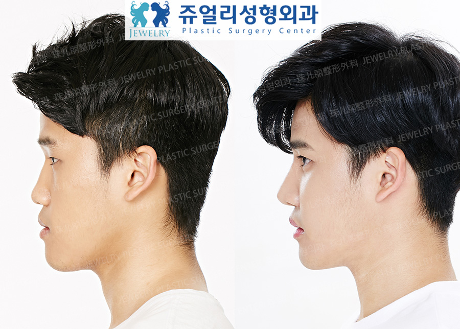 その他の術前・術後写真 3