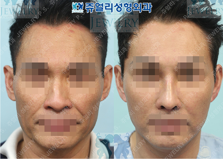 アンチエイジング・リフトの術前・術後写真 1