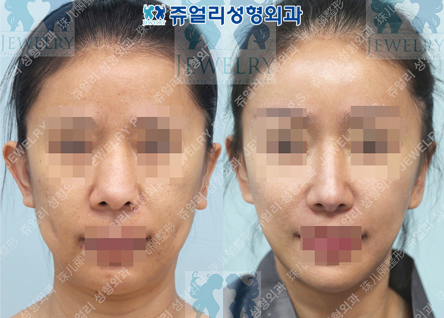 アンチエイジング・リフトの術前・術後写真 1