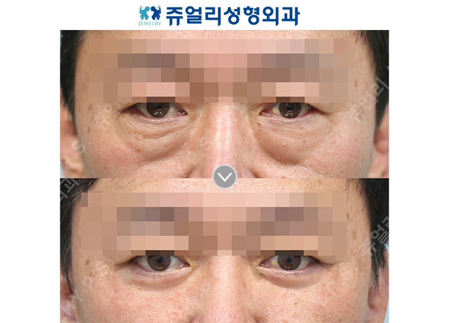 目の整形の術前・術後写真