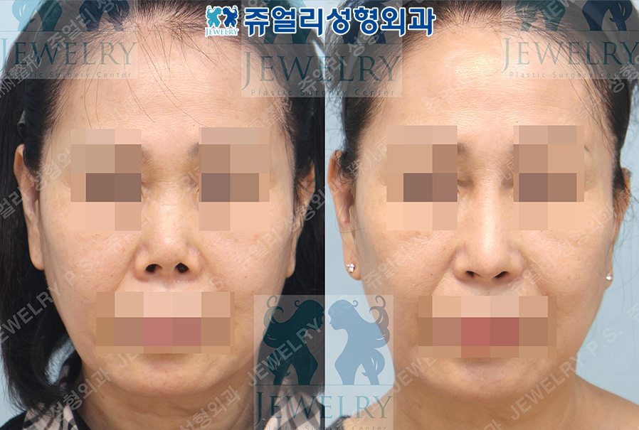 鼻の整形の術前・術後写真 1