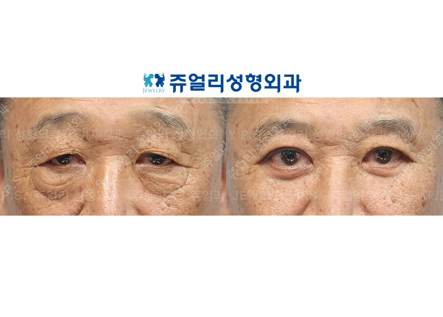 目の整形の術前・術後写真