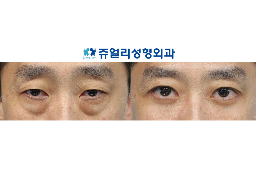 目の整形の術前・術後写真