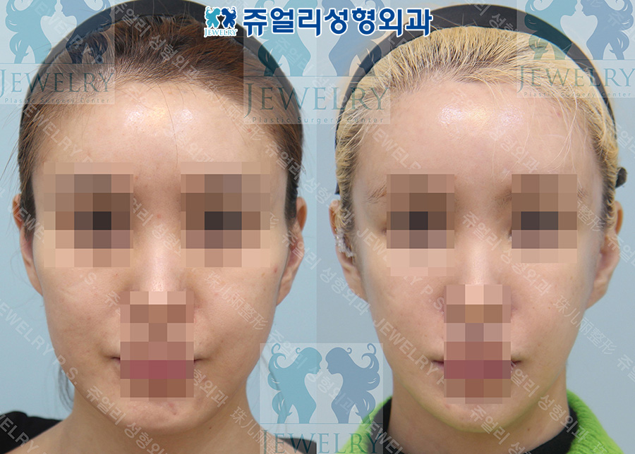 輪郭整形の術前・術後写真 1