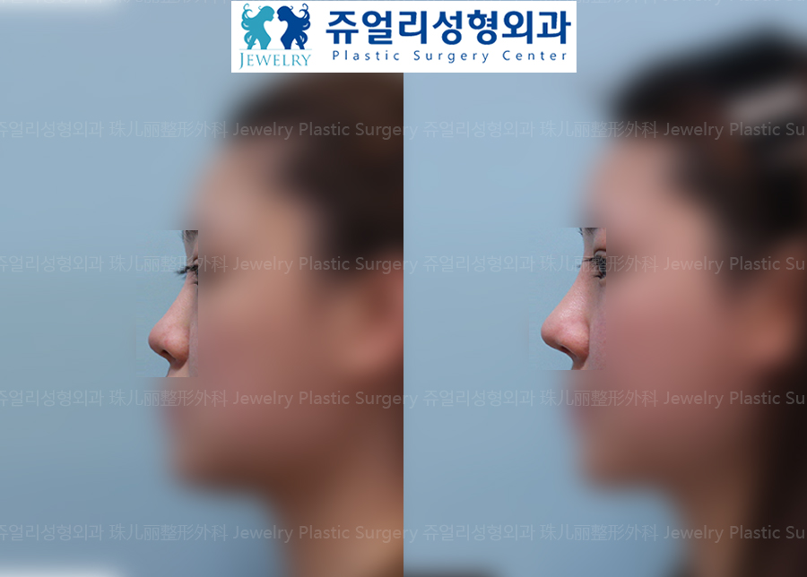 鼻の整形の術前・術後写真