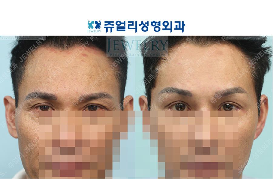 アンチエイジング・リフトの術前・術後写真
