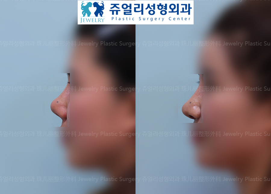 鼻の整形の術前・術後写真 1