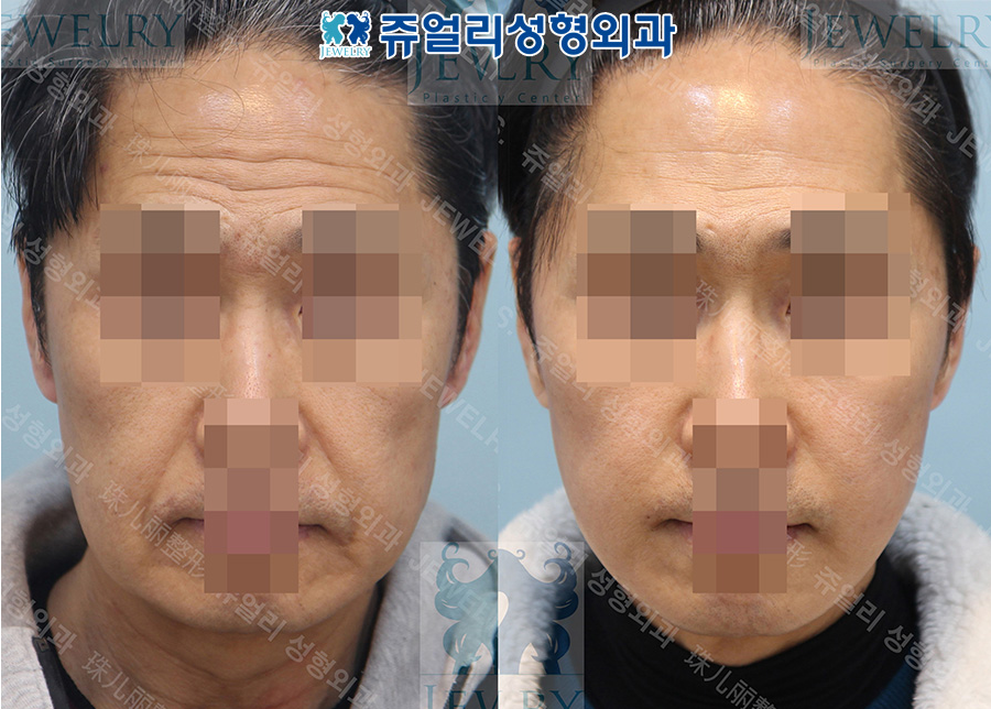 アンチエイジング・リフトの術前・術後写真 1