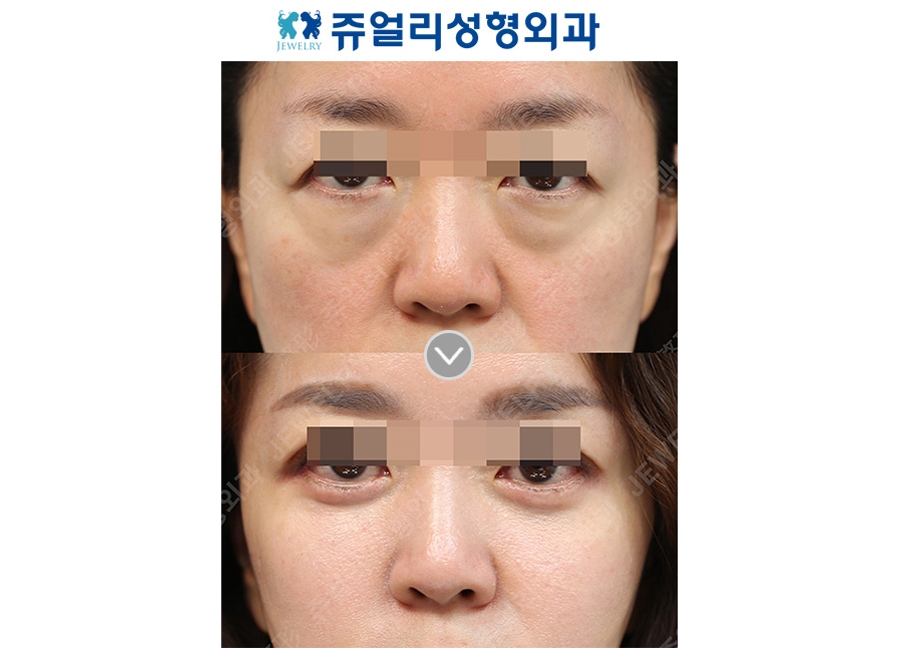 目の整形の術前・術後写真