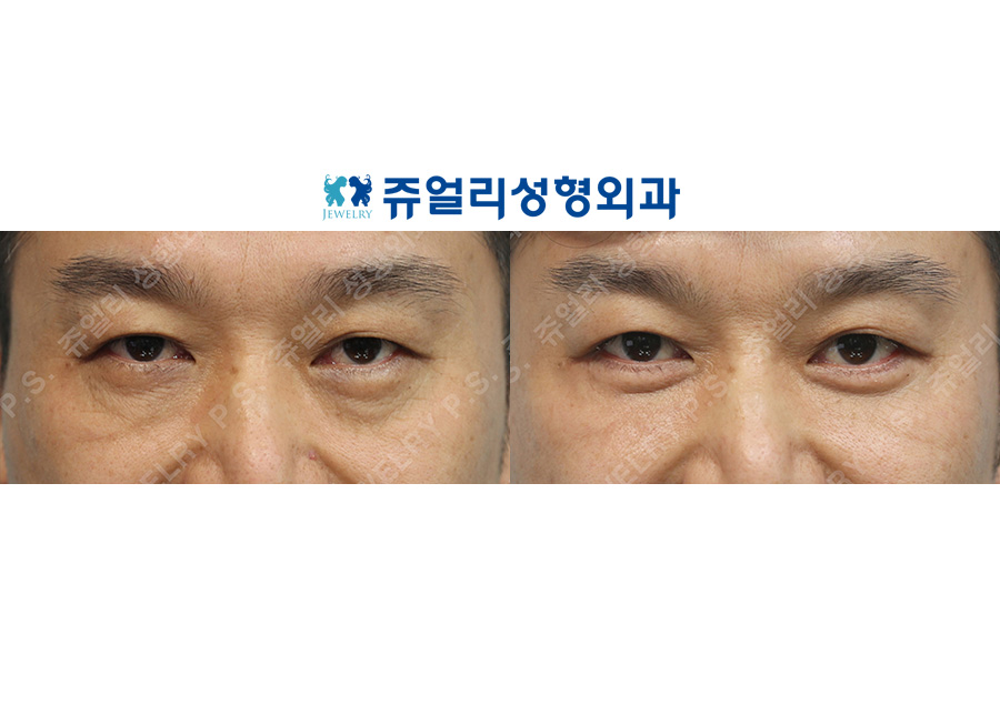 目の整形の術前・術後写真