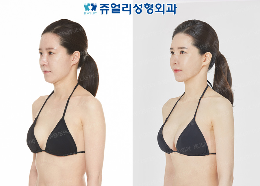 豊胸の術前・術後写真 2