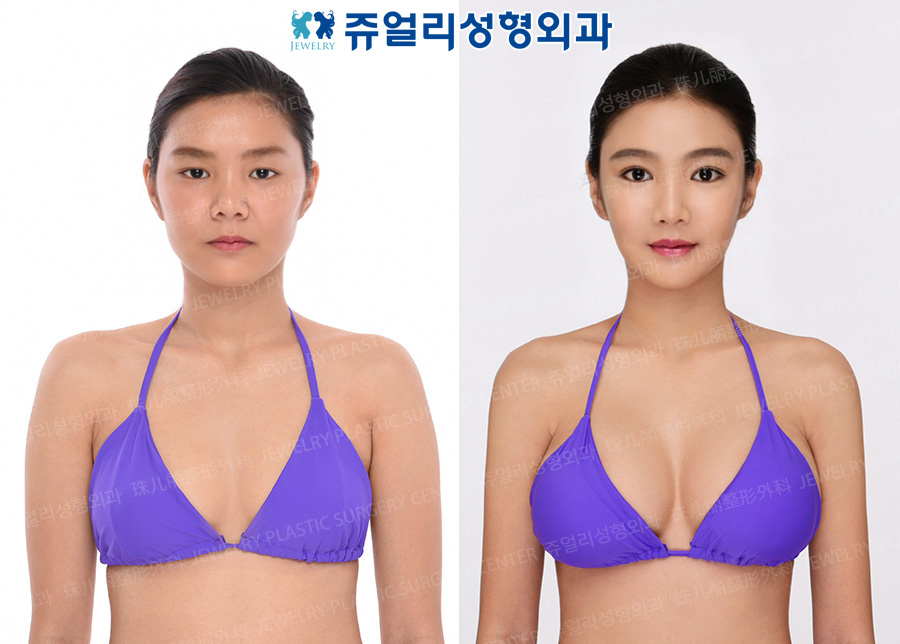 豊胸の術前・術後写真 1