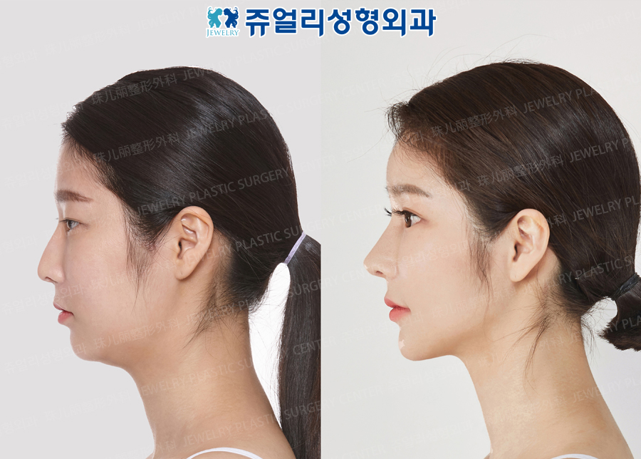 その他の術前・術後写真 3