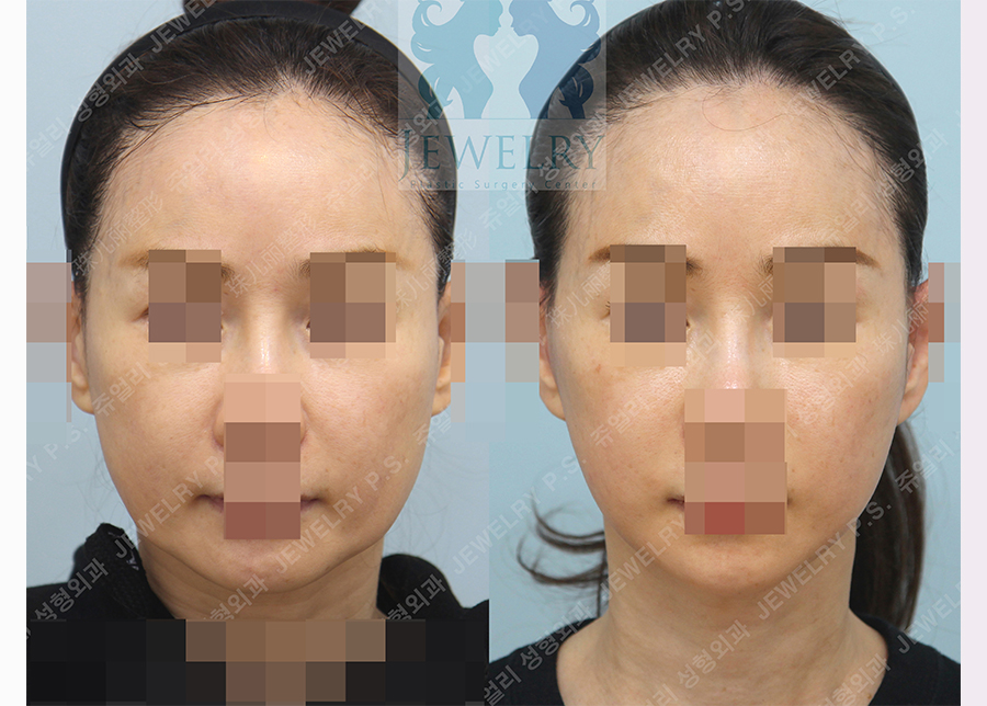 アンチエイジング・リフトの術前・術後写真 1