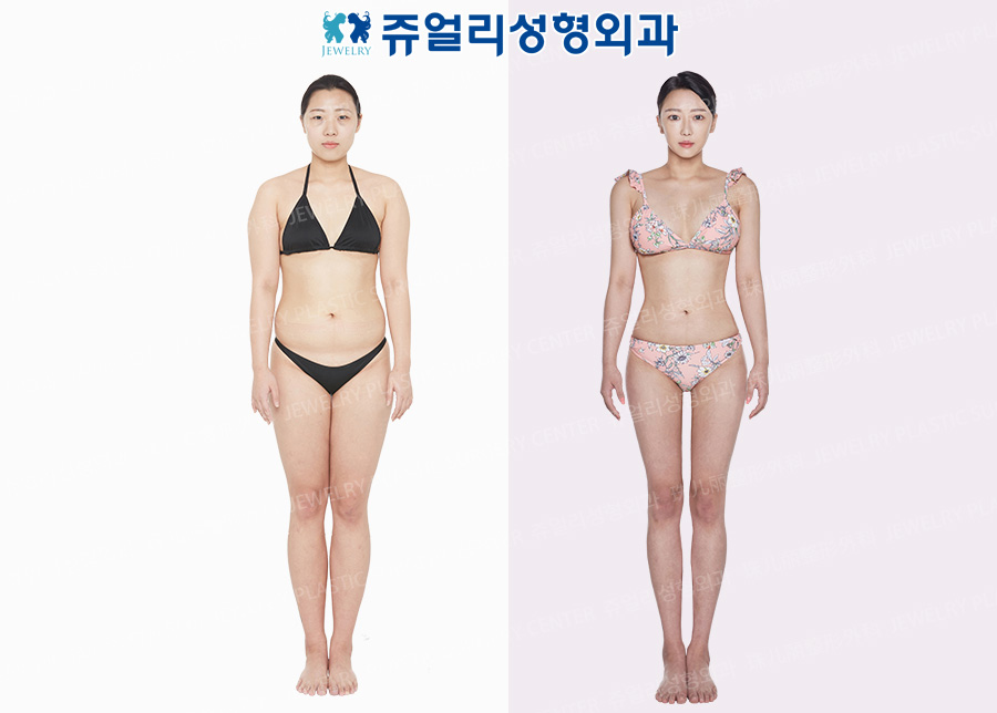 ボディ整形の術前・術後写真 1