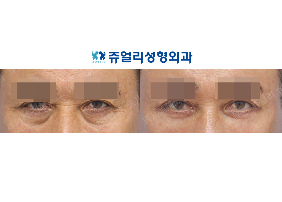 目の整形の術前・術後写真