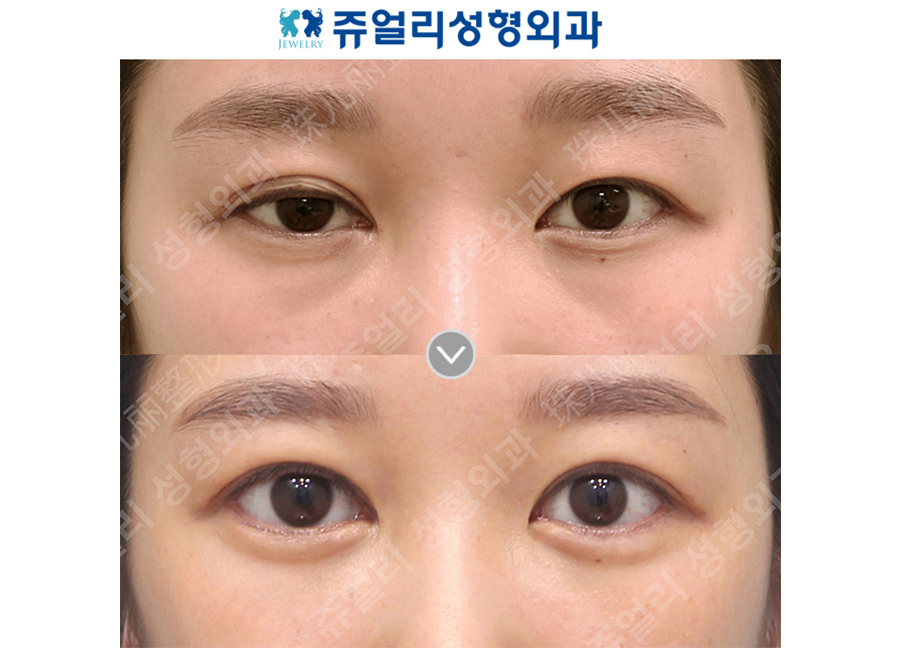 目の整形の術前・術後写真