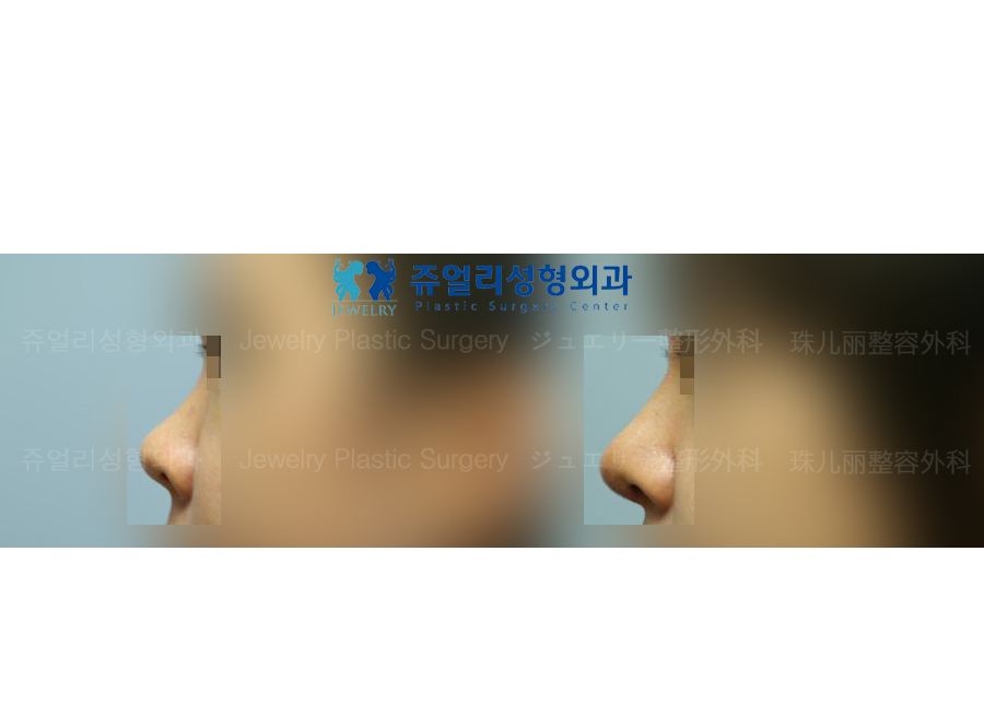 鼻の整形の術前・術後写真