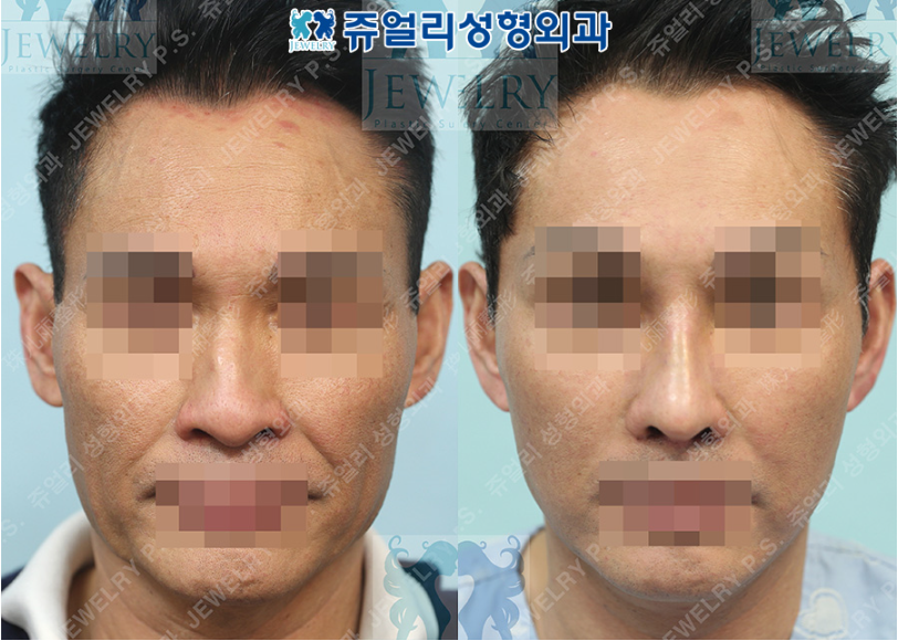 鼻の整形の術前・術後写真 1