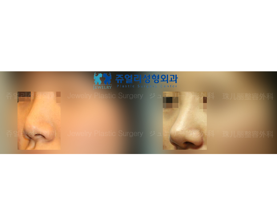 鼻の整形の術前・術後写真 1
