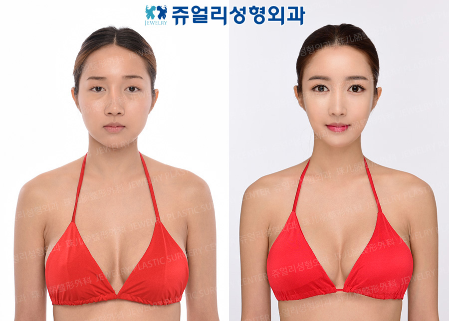 豊胸の術前・術後写真 1
