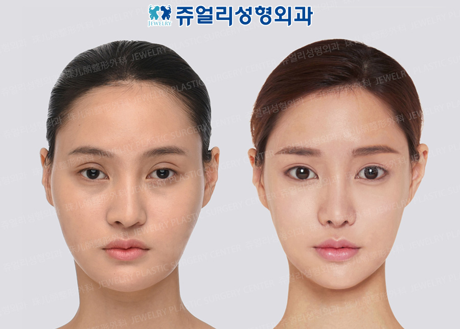 その他の術前・術後写真 1