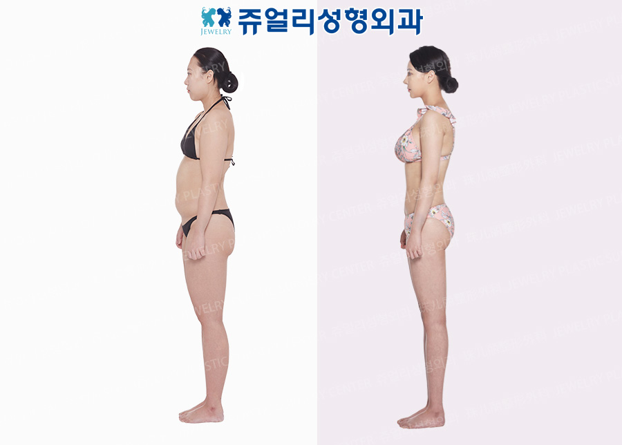 ボディ整形の術前・術後写真 3