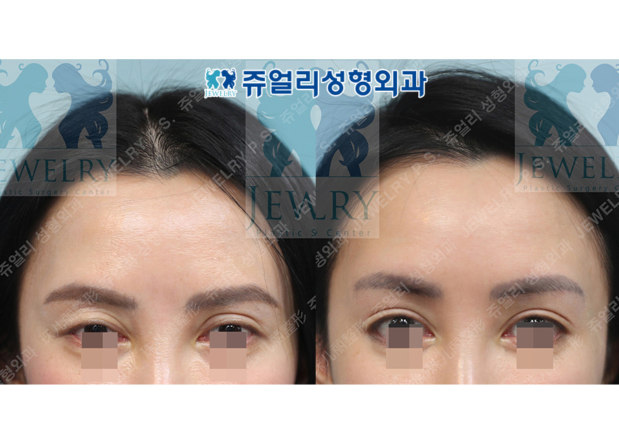 アンチエイジング・リフトの術前・術後写真