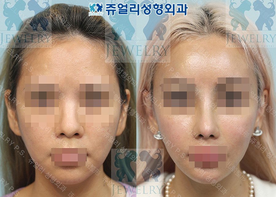 鼻の整形の術前・術後写真 1