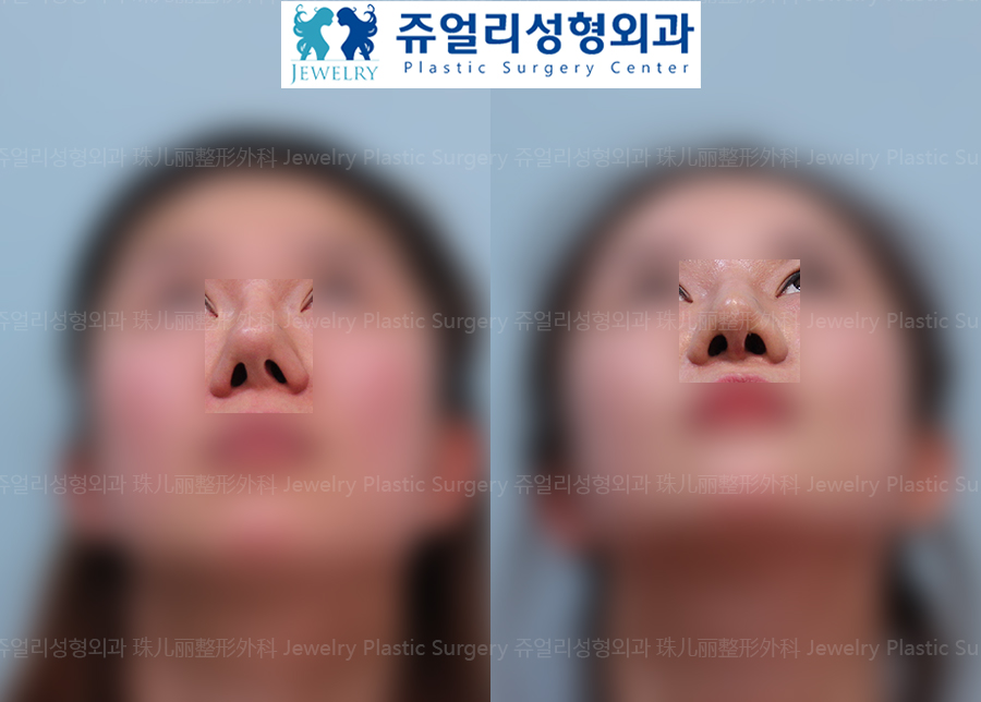 鼻の整形の術前・術後写真 3