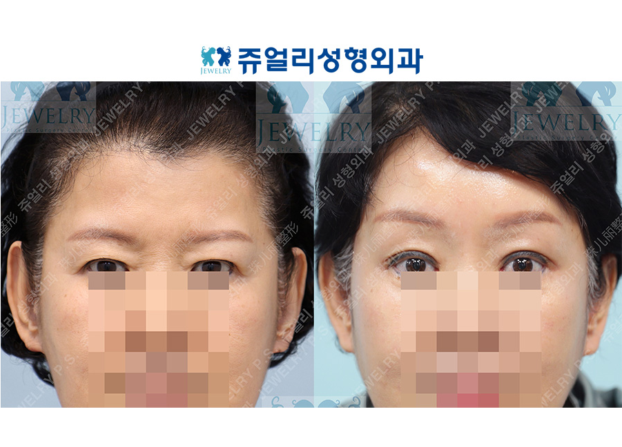 アンチエイジング・リフトの術前・術後写真 1