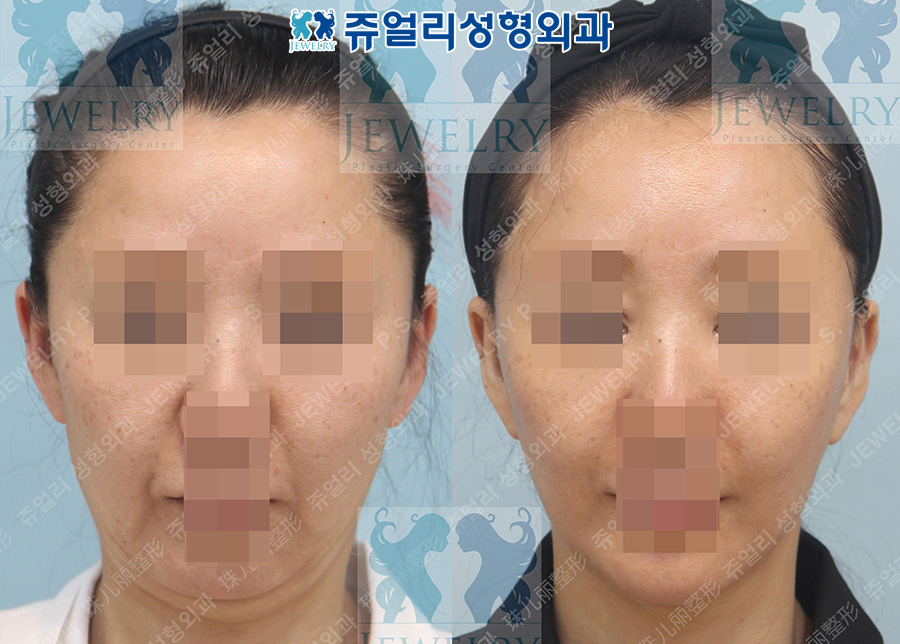 アンチエイジング・リフトの術前・術後写真 1
