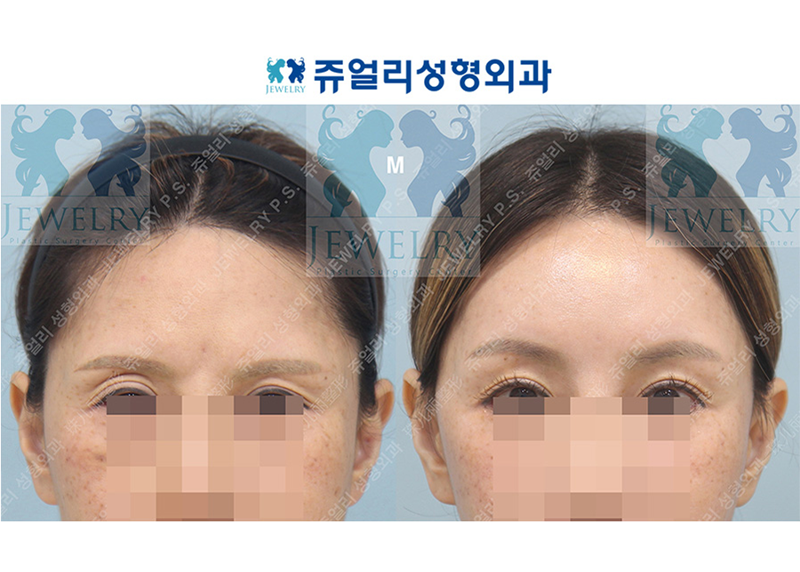 アンチエイジング・リフトの術前・術後写真
