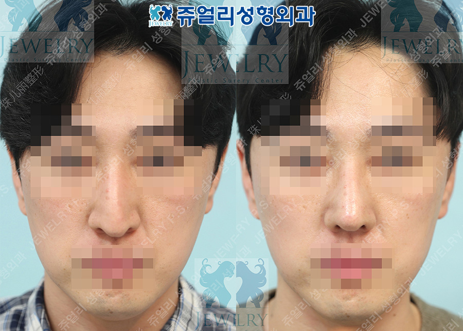 鼻の整形の術前・術後写真 1