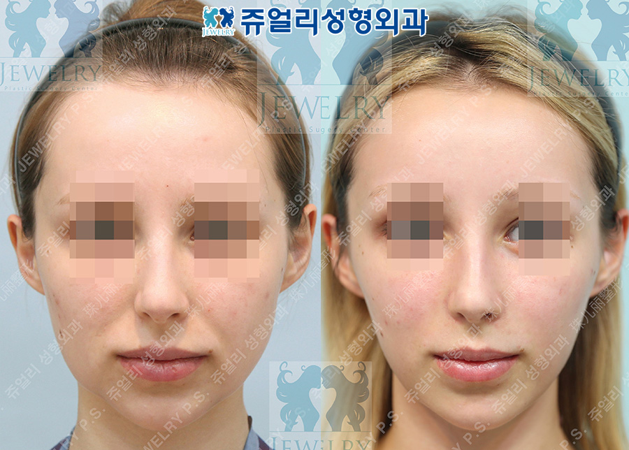 アンチエイジング・リフトの術前・術後写真 1
