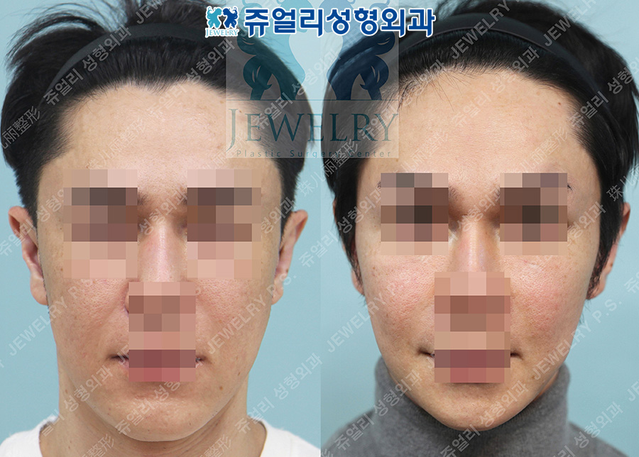 輪郭整形の術前・術後写真 1