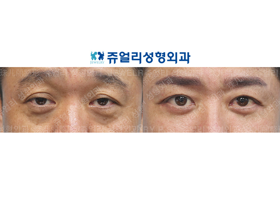 目の整形の術前・術後写真