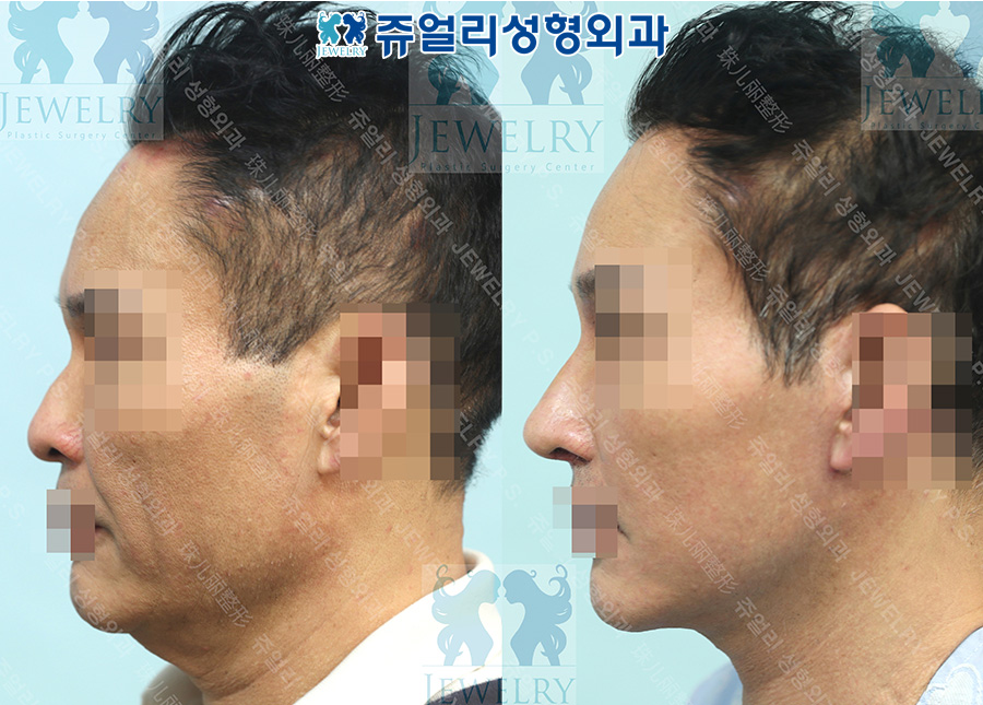 アンチエイジング・リフトの術前・術後写真 3