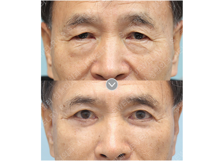 目の整形の術前・術後写真