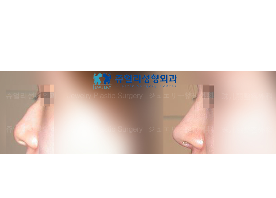 鼻の整形の術前・術後写真
