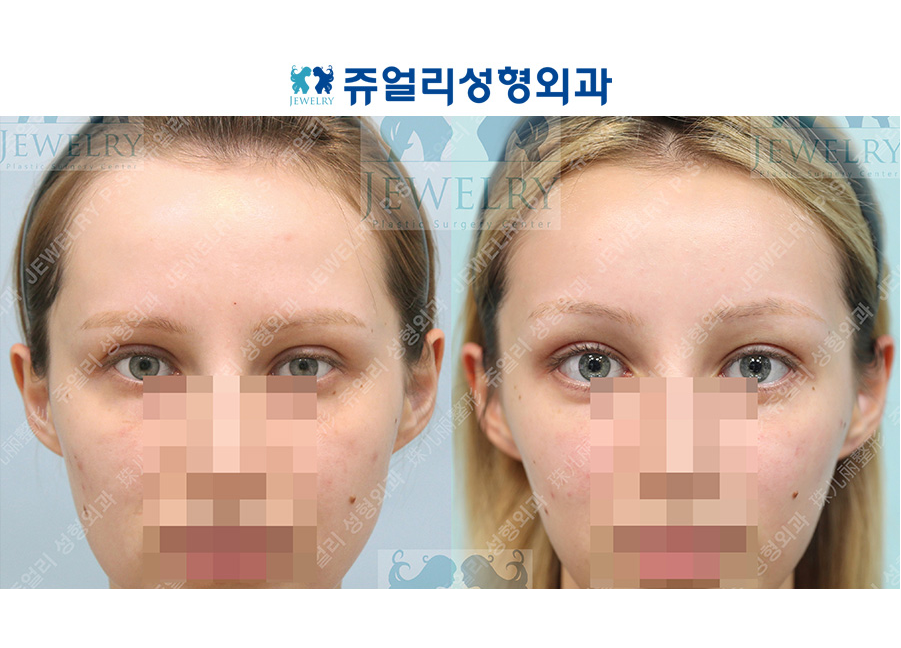 アンチエイジング・リフトの術前・術後写真