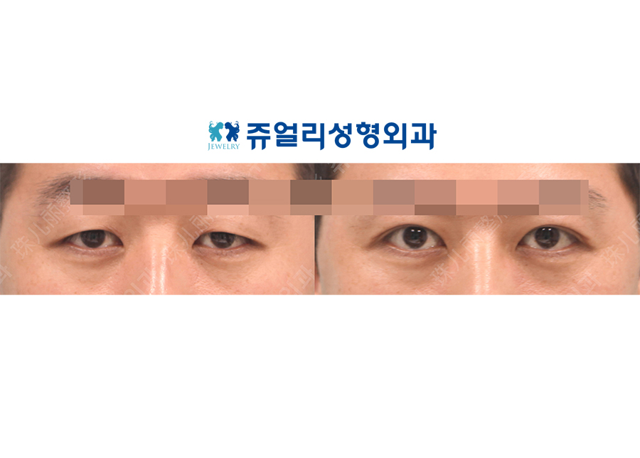 目の整形の術前・術後写真