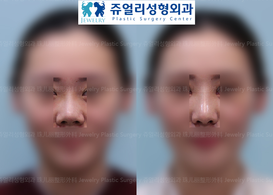 鼻の整形の術前・術後写真 1