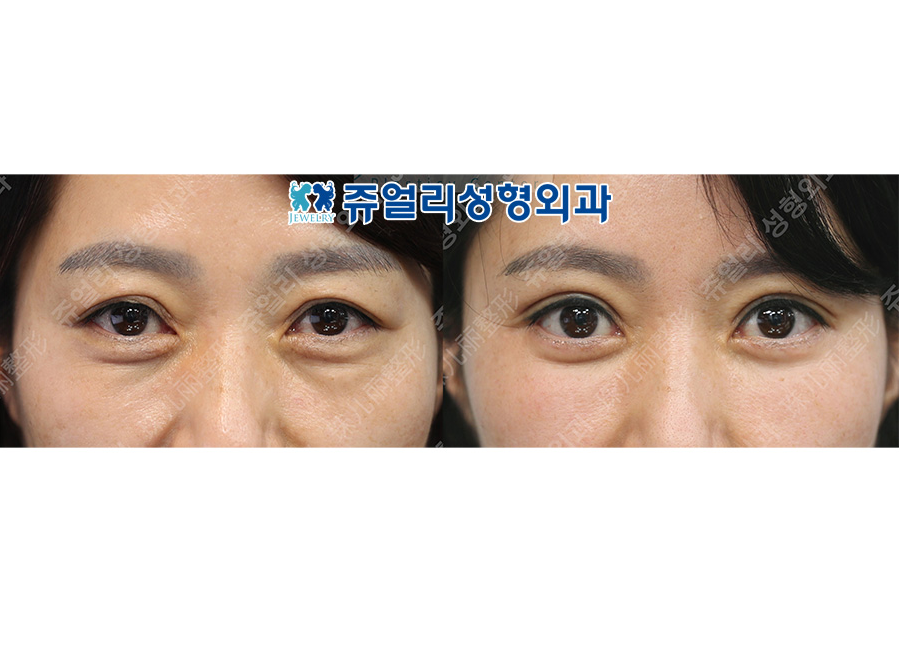目の整形の術前・術後写真