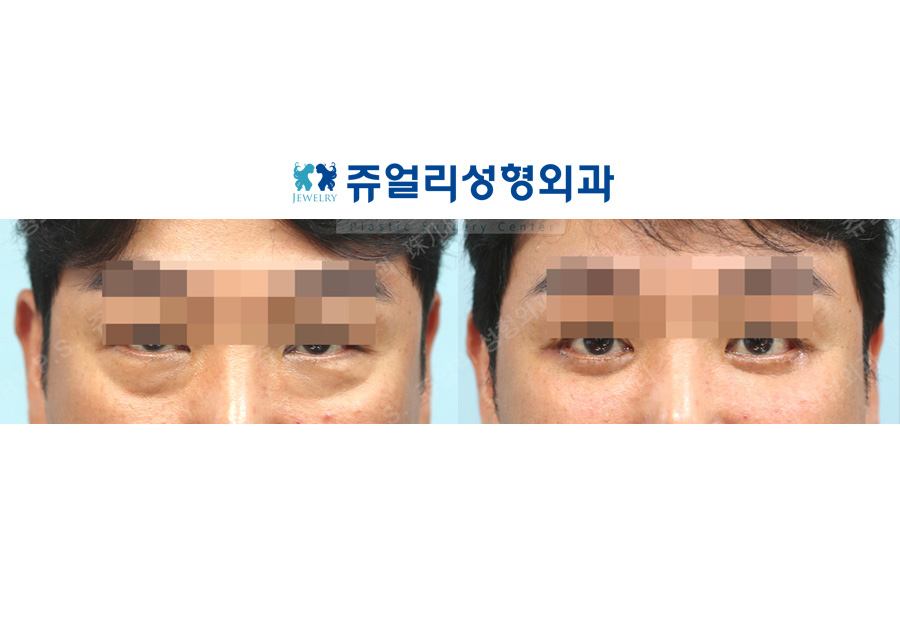 目の整形の術前・術後写真