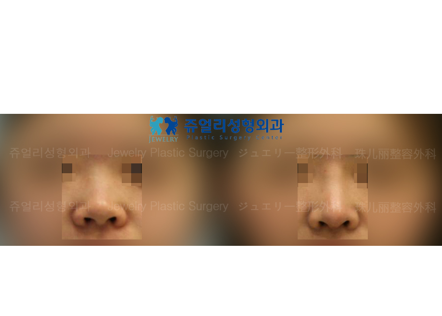 鼻の整形の術前・術後写真 1