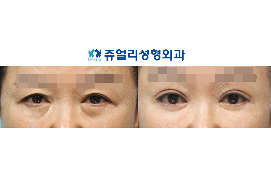 目の整形の術前・術後写真