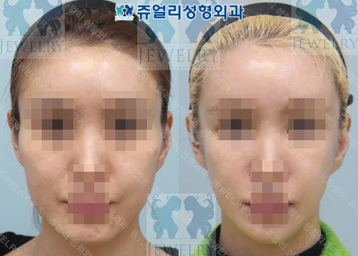 輪郭整形の術前・術後写真 1